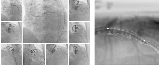 左目XperSwing臨床症例画像、右目Stentboost