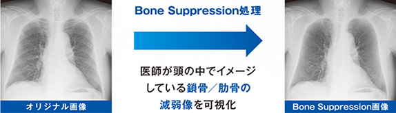 BoneSuppression